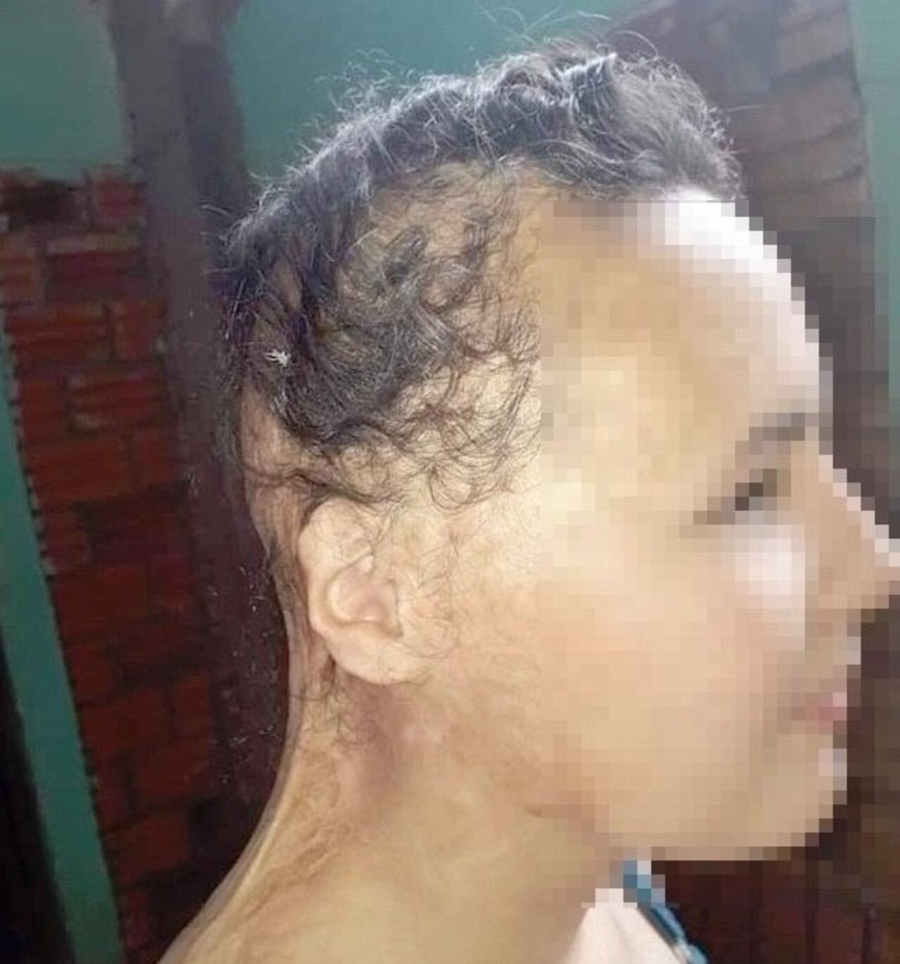 La adolescente sufrió quemaduras en gran parte de su cabeza y su espalda. (Crédito: Nolvia Barrios)