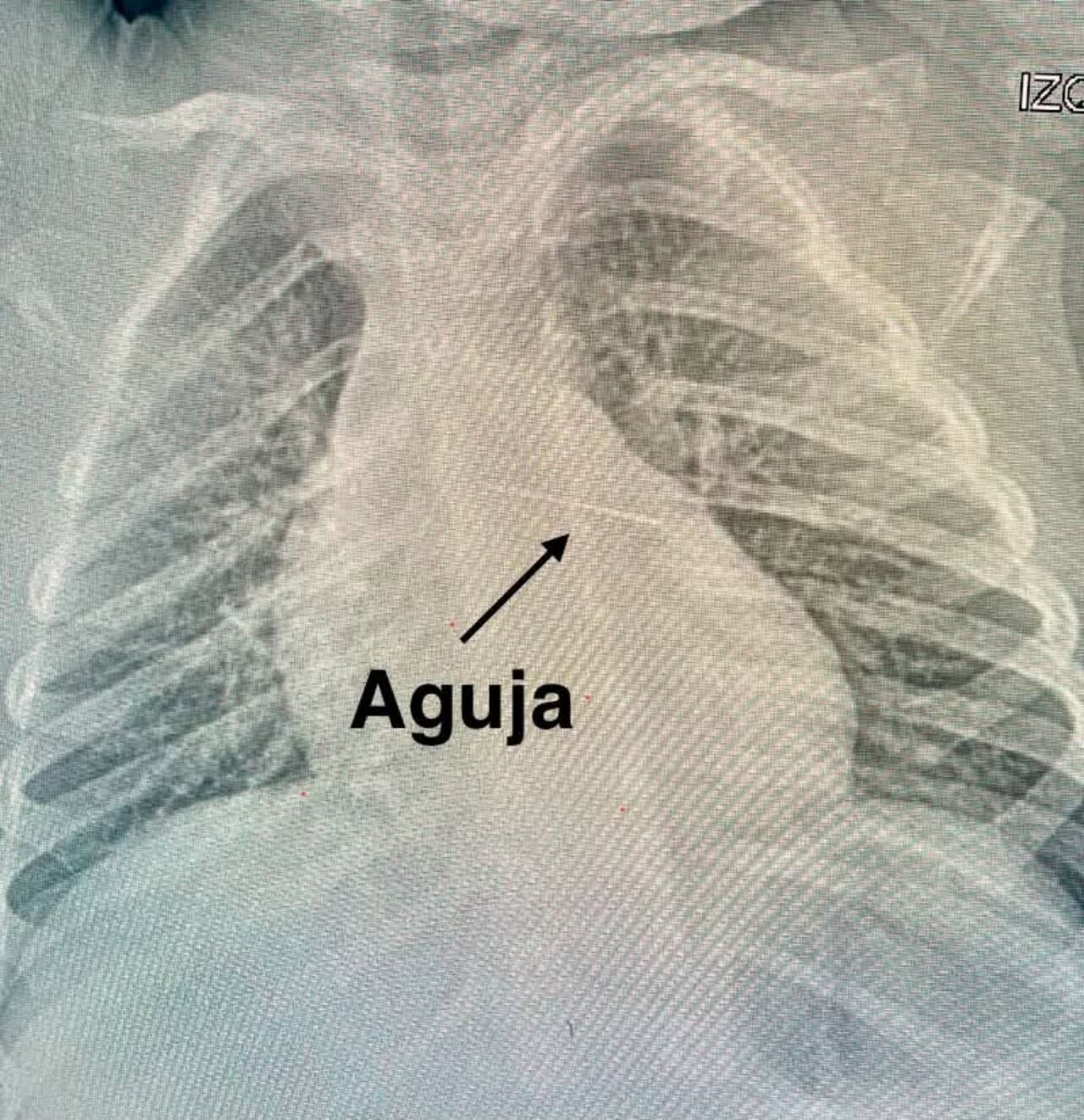 Exitoso procedimiento médico por parte del doctor Carlos Morínigo.