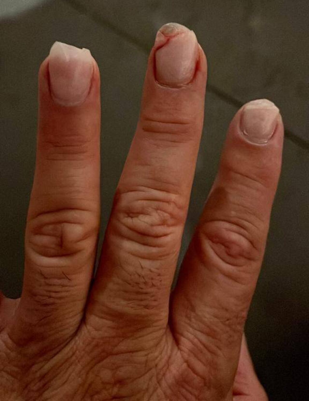Así queddaron los dedos de la mano del artista compatriota, tras un percance justo antes de su show. (FOTO: Gentileza)