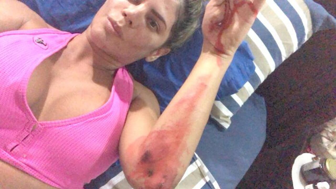 La modelo mostró las heridas con las que se quedó luego del vuelco.