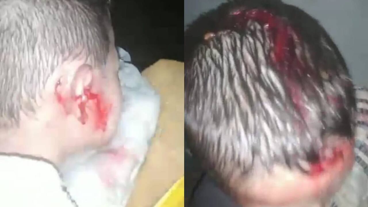 Varios niños resultaron con heridas en la cabeza a consecuencia de los granizos. Gentileza
