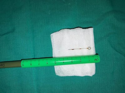Salvan a bebé de 2 años que tragó un alfiler
