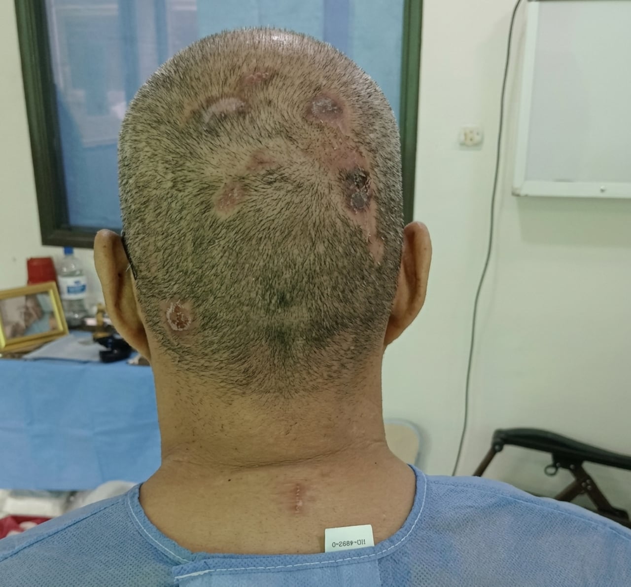 Las heridas que presenta Hugo Javier en la cabeza.