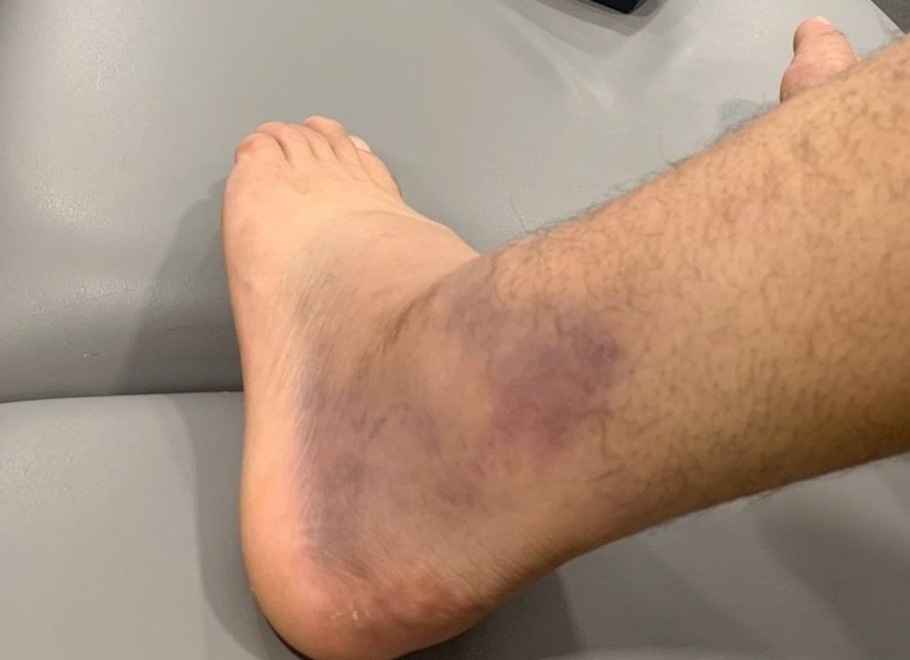 Walter González publicó la foto de su tobillo.