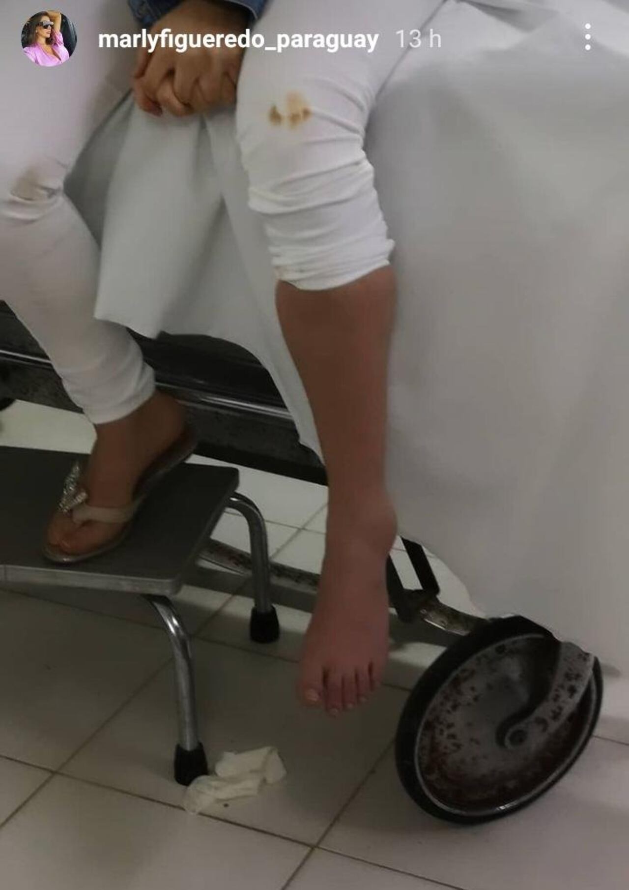 Esguince severo de tobillo grado 3. Así quedó el pie de la joven. (@MARLYFIGUEREDO_PARAGUAY)
